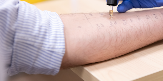 Person being tested for allergies